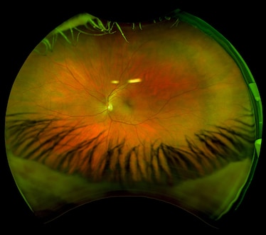 An ultra wide digital retinal scan of a human eye showing the veins and capillaries in a retina